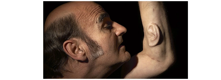 Top 10 People With Extra Body Parts