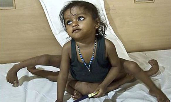 Top 10 People With Extra Body Parts